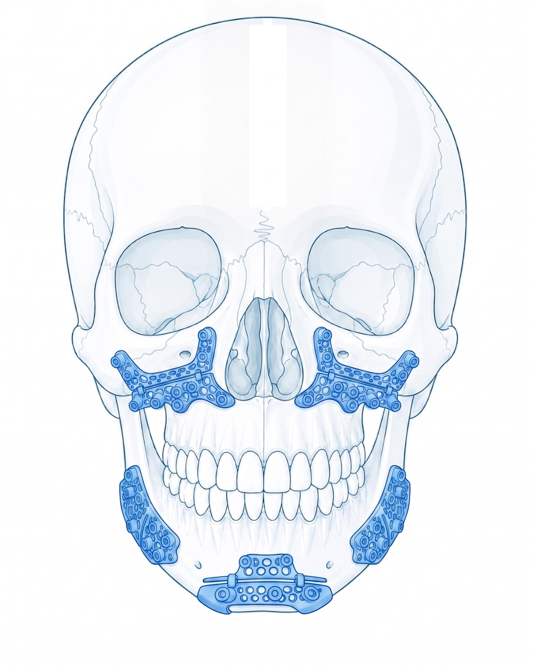 Frontal skull with patient specific orthognathic guide and fixation design